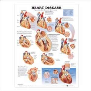  Heart Disease Anatomical Chart 20 X 26 Laminated Health 