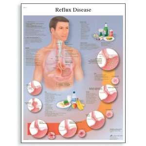   Reflux Disease Anatomical Chart, Poster Size 20 Width x 26 Height