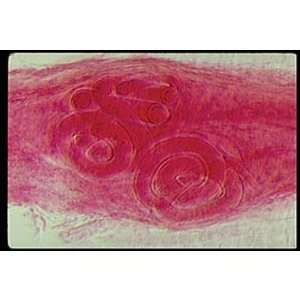 Trichinella spiralis Encysted Larvae, w.m. Microscope Slide:  