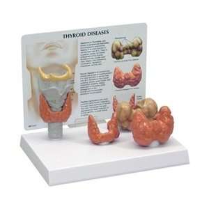 Human Thyroid Diseases Anatomy Model wiith Patient Education Card 